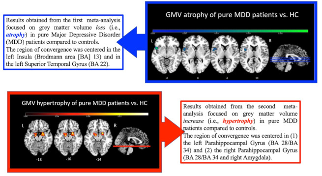 “The dark and gloomy brain”: due metanalisi sulle alterazioni del volume di materia grigia nel disturbo depressivo maggiore